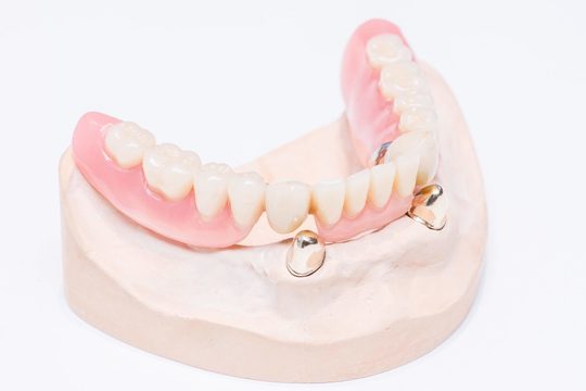 義歯　入れ歯　見本 入れ歯の種類：入れ歯（義歯） - 渡辺歯科医院